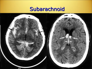 Subarachnoid  Hemorrhage 