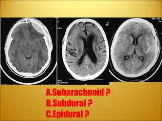 Review Subarachnoid ? Subdural ?   Epidural ?   