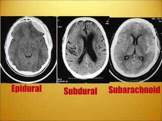 Review Subdural   Epidural  Subarachnoid 
