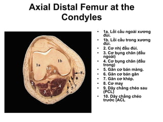 Axial Distal Femur at the Condyles 1a. Lồi cầu ngoài xương đùi. 1b. Lồi cầu trong xương đùi. 2. Cơ nhị đầu đùi. 3. Cơ bụng chân (đầu ngoài) 4. Cơ bụng chân (đầu trong)  5. Gân cơ bán màng. 6. Gân cơ bán gân 7. Gân cơ khép. 8. Cơ may 9. Dây chằng chéo sau   (PCL)  10. Dây chằng chéo trước (ACL 