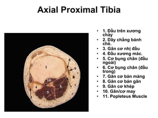 Axial Proximal Tibia 1. Đầu trên xương chày 2. Dây chằng bánh chè. 3. Gân cơ nhị đầu 4. Đầu xương mác. 5. Cơ bụng chân (đầu ngoài) 6. Cơ bụng chân (đầu trong) 7. Gân cơ bán màng 8. Gân cơ bán gân 9. Gân cơ khép 10. Gân/cơ may 11. Popleteus Muscle 