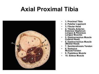 Axial Proximal Tibia 1. Proximal Tibia 2. Patellar Ligament  3. Fibular Head  4. Tibialis Anterior, Extensor Digitorum Longus & Peroneus Longus Muscles 5. Gastrocnemius Muscle (Lateral Head) 6. Gastrocnemius Muscle (Medial Head)  7. Semitendinosis Tendon  8. Sartorius Muscle/Tendon  9. Popleteus Muscle 10. Soleus Muscle 
