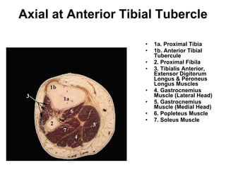 Axial at Anterior Tibial Tubercle 1a. Proximal Tibia 1b. Anterior Tibial Tubercule 2. Proximal Fibila 3. Tibialis Anterior, Extensor Digitorum Longus & Peroneus Longus Muscles 4. Gastrocnemius Muscle (Lateral Head) 5. Gastrocnemius Muscle (Medial Head)  6. Popleteus Muscle  7. Soleus Muscle 