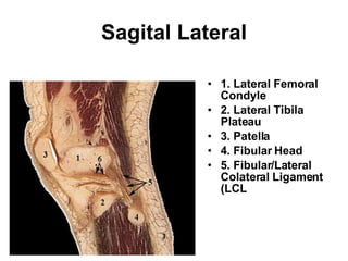 Sagital Lateral 1. Lateral Femoral Condyle  2. Lateral Tibila Plateau 3. Patella  4. Fibular Head  5. Fibular/Lateral Colateral Ligament (LCL 