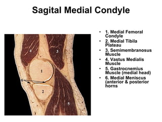 Sagital Medial Condyle 1. Medial Femoral Condyle  2. Medial Tibila Plateau  3. Semimembranosus Muscle  4. Vastus Medialis Muscle  5. Gastrocnemius Muscle (medial head)  6. Medial Meniscus (anterior & posterior horns 
