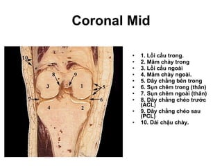 Coronal Mid 1. Lồi cầu trong. 2. Mâm chày trong 3. Lồi cầu ngoài 4. Mâm chày ngoài. 5. Dây chằng bên trong 6. Sụn chêm trong (thân) 7. Sụn chêm ngoài (thân) 8. Dây chằng chéo trước (ACL) 9. Dây chằng chéo sau   (PCL) 10. Dải chậu chày. 