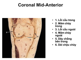 Coronal Mid-Anterior 1. Lồi cầu trong 2. Mâm chày trong 3. Lồi cầu ngoài 4. Mâm chày ngoài 5. Dây chằng bên trong 6. Dải chậu chày 