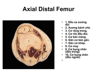 Axial Distal Femur 1. Đầu xa xương đùi 2. Xương bánh chè. 3. Cơ rộng trong. 4. Cơ nhị đầu đùi. 5. Cơ bán màng. 6. Gân cơ bán gân. 7. Gân cơ khép. 8. Cơ may 9. Cơ bụng chân (đầu trong)  10. Cơ bụng chân (đầu ngoài).   