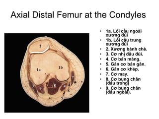 Axial Distal Femur at the Condyles  1a. Lồi cầu ngoài xương đùi  1b. Lồi cầu trung xương đùi 2. Xương bánh chè.  3. Cơ nhị đầu đùi. 4. Cơ bán màng. 5. Gân cơ bán gân. 6. Gân cơ khép. 7. Cơ may. 8. Cơ bụng chân (đầu trong)  9. Cơ bụng chân (đầu ngoài). 