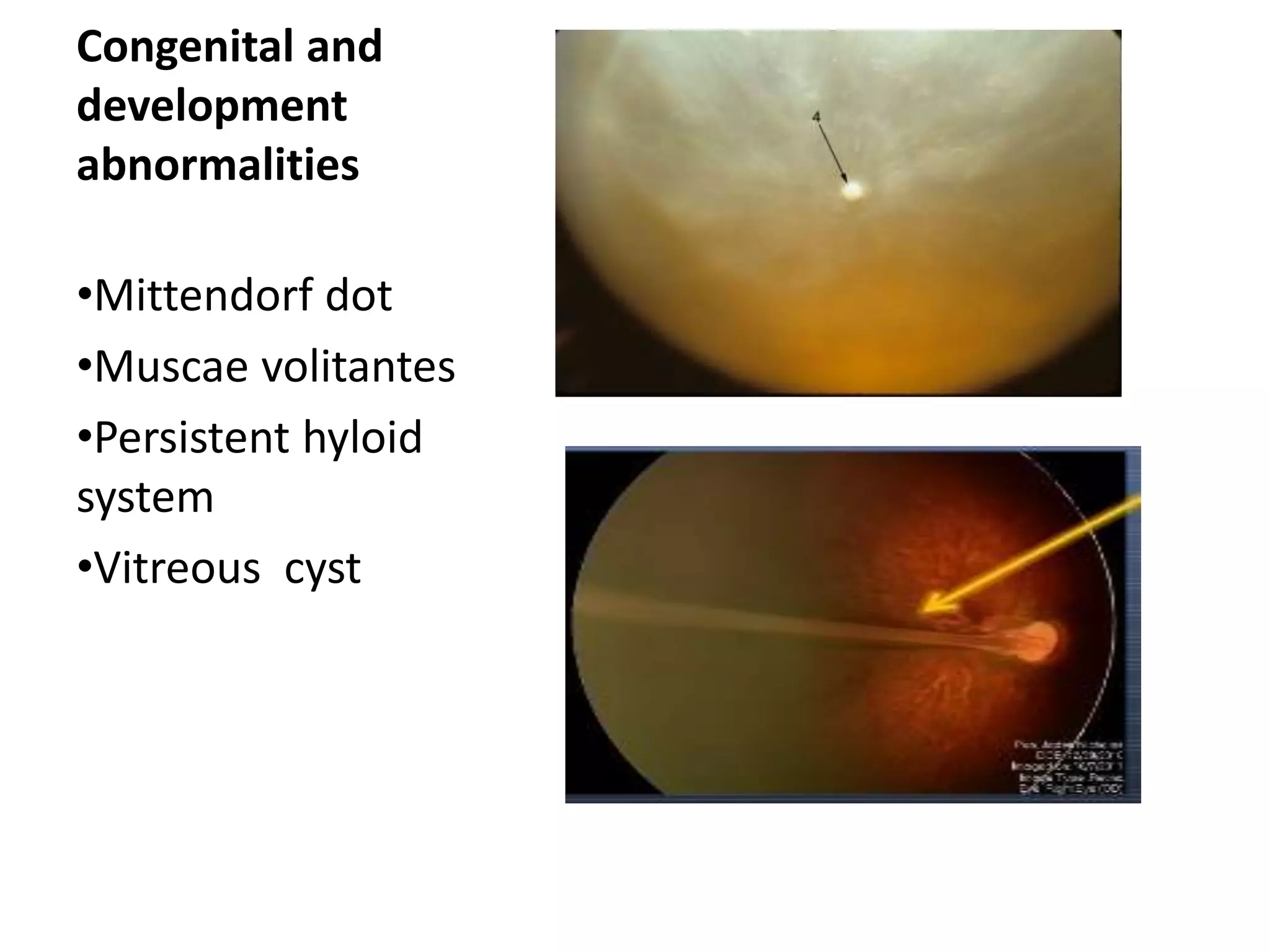 Anatomy of vitreous | PPTX