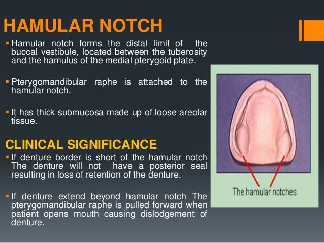 hamular notch