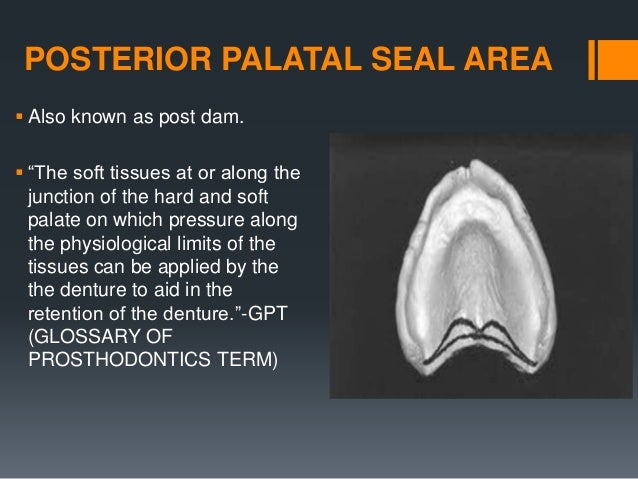 anatomy and clinical significance of denture bearing areas hamular notch