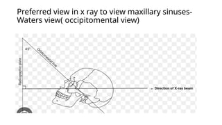 Walters View ANATOMY AND DEVELOPMENT OF PARANASAL SINUSES 2.pptx