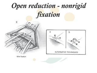 Anatomy and fractures of the mandible | PPT