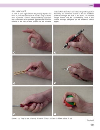 Joint replacement
As with all joint replacements the primary object is the
relief of pain and restoration of as full a range of move-
ment as possible. However, when considering finger joint
replacements the main problem appears to be the main-
tenance of the cortical bone. Stresses on the endosteal
surface of the bone have a tendency to produce gradual
deformity, and sometimes erosion so that the prosthesis
protrudes through the shaft of the bone. The inserted
foreign material may be a contributory factor in this
erosion through disruption of the endosteal arterial
supply.
A B
C D
E F
Figure 2.129 Types of grip: (A) pincer, (B) tripod, (C) pinch, (D) key, (E) oblique palmar, (F) ball,
Continued
Joints
181
 