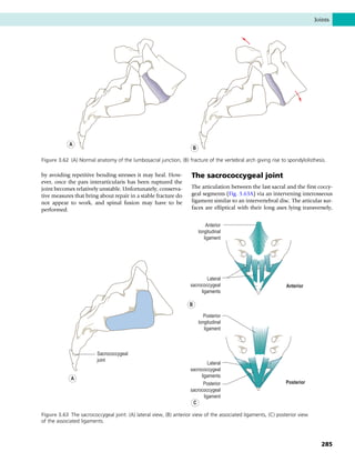 by avoiding repetitive bending stresses it may heal. How-
ever, once the pars interarticularis has been ruptured the
joint becomes relatively unstable. Unfortunately, conserva-
tive measures that bring about repair in a stable fracture do
not appear to work, and spinal fusion may have to be
performed.
The sacrococcygeal joint
The articulation between the last sacral and the first coccy-
geal segments (Fig. 3.63A) via an intervening interosseous
ligament similar to an intervertebral disc. The articular sur-
faces are elliptical with their long axes lying transversely,
B
A
Figure 3.62 (A) Normal anatomy of the lumbosacral junction, (B) fracture of the vertebral arch giving rise to spondylolisthesis.
Anterior
longitudinal
ligament
Lateral
sacrococcygeal
ligaments
Anterior
Posterior
longitudinal
ligament
Lateral
sacrococcygeal
ligaments
Posterior
sacrococcygeal
ligament
Sacrococcygeal
joint
Posterior
A
C
B
Figure 3.63 The sacrococcygeal joint: (A) lateral view, (B) anterior view of the associated ligaments, (C) posterior view
of the associated ligaments.
Joints
285
 