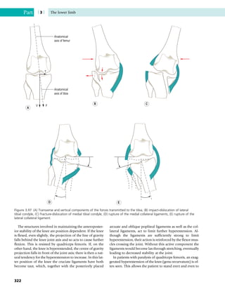 The structures involved in maintaining the anteroposter-
ior stability of the knee are position dependent. If the knee
is flexed, even slightly, the projection of the line of gravity
falls behind the knee joint axis and so acts to cause further
flexion. This is resisted by quadriceps femoris. If, on the
other hand, the knee is hyperextended, the centre of gravity
projection falls in front of the joint axis; there is then a nat-
ural tendency for the hyperextension to increase. In this lat-
ter position of the knee the cruciate ligaments have both
become taut, which, together with the posteriorly placed
arcuate and oblique popliteal ligaments as well as the col-
lateral ligaments, act to limit further hyperextension. Al-
though the ligaments are sufficiently strong to limit
hyperextension, their action is reinforced by the flexor mus-
cles crossing the joint. Without this active component the
ligaments would become lax through stretching, eventually
leading to decreased stability at the joint.
In patients with paralysis of quadriceps femoris, an exag-
gerated hyperextension of the knee (genu recurvatum) is of-
ten seen. This allows the patient to stand erect and even to
Anatomical
axis of femur
Anatomical
axis of tibia
V F
T
E
D
C
B
A
Figure 3.97 (A) Transverse and vertical components of the forces transmitted to the tibia, (B) impact-dislocation of lateral
tibial condyle, (C) fracture-dislocation of medial tibial condyle, (D) rupture of the medial collateral ligaments, (E) rupture of the
lateral collateral ligament.
Part | 3 | The lower limb
322
 