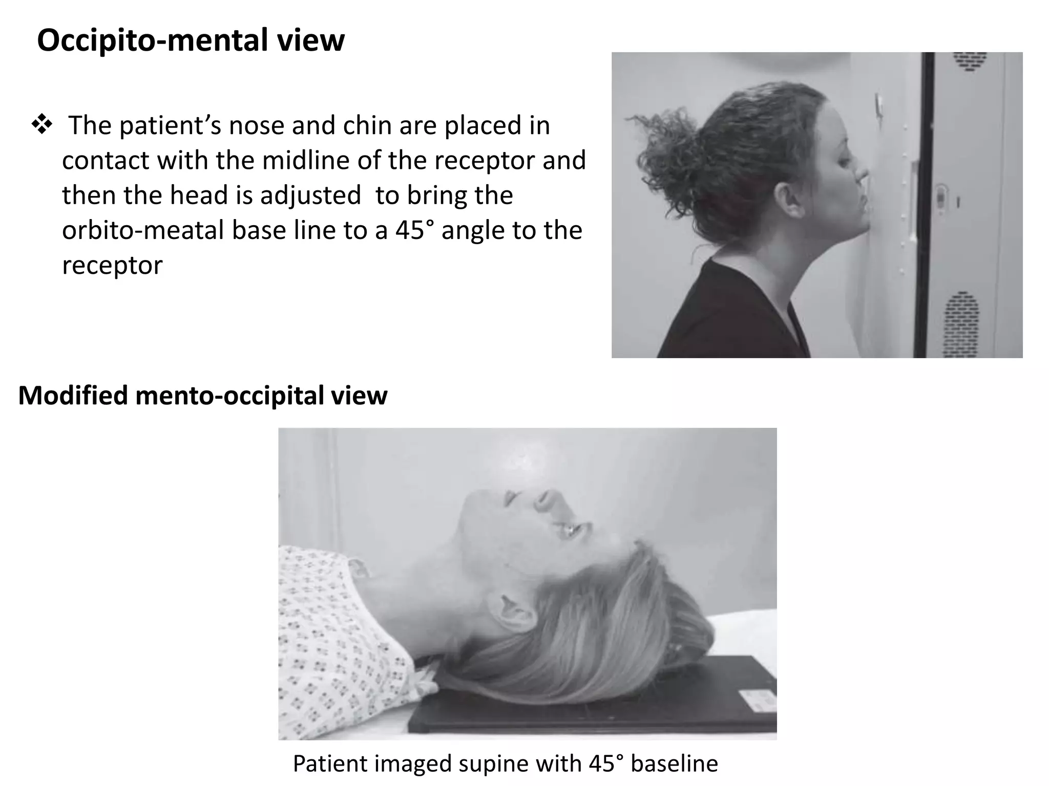 Occipito-mental view
Patient imaged supine with 45° baseline
Modified mento-occipital view
 The patient’s nose and chin are placed in
contact with the midline of the receptor and
then the head is adjusted to bring the
orbito-meatal base line to a 45° angle to the
receptor
 