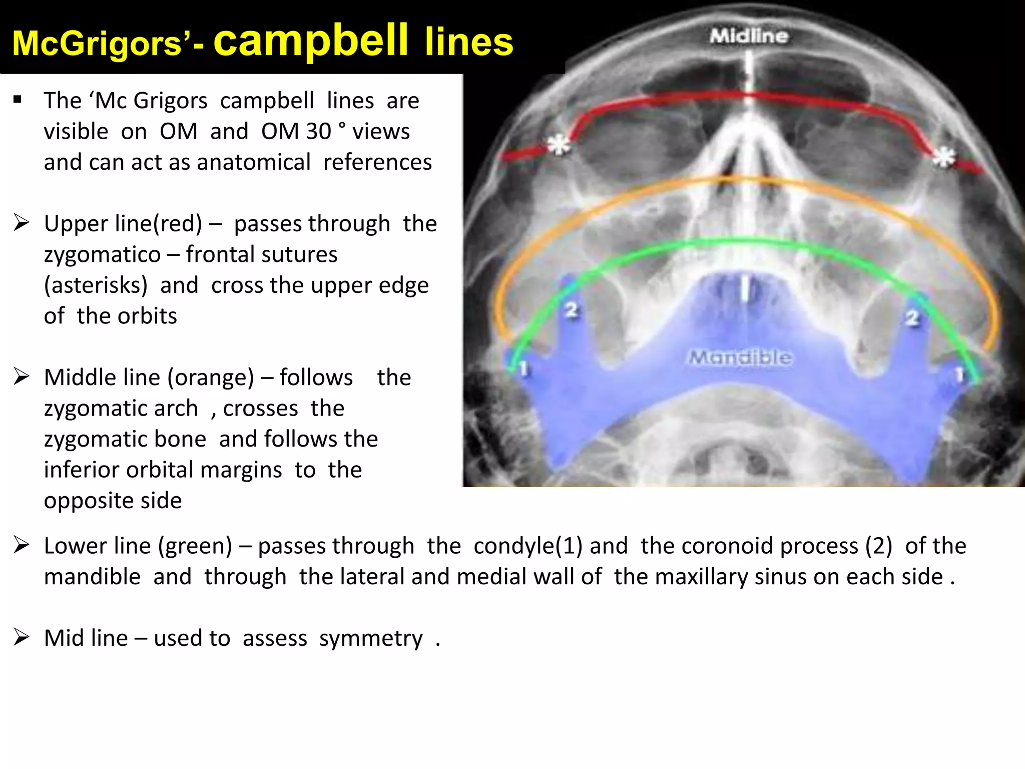 McGrigors’- campbell lines
 The ‘Mc Grigors campbell lines are
visible on OM and OM 30 ° views
and can act as anatomical references
 Upper line(red) – passes through the
zygomatico – frontal sutures
(asterisks) and cross the upper edge
of the orbits
 Middle line (orange) – follows the
zygomatic arch , crosses the
zygomatic bone and follows the
inferior orbital margins to the
opposite side
 Lower line (green) – passes through the condyle(1) and the coronoid process (2) of the
mandible and through the lateral and medial wall of the maxillary sinus on each side .
 Mid line – used to assess symmetry .
 