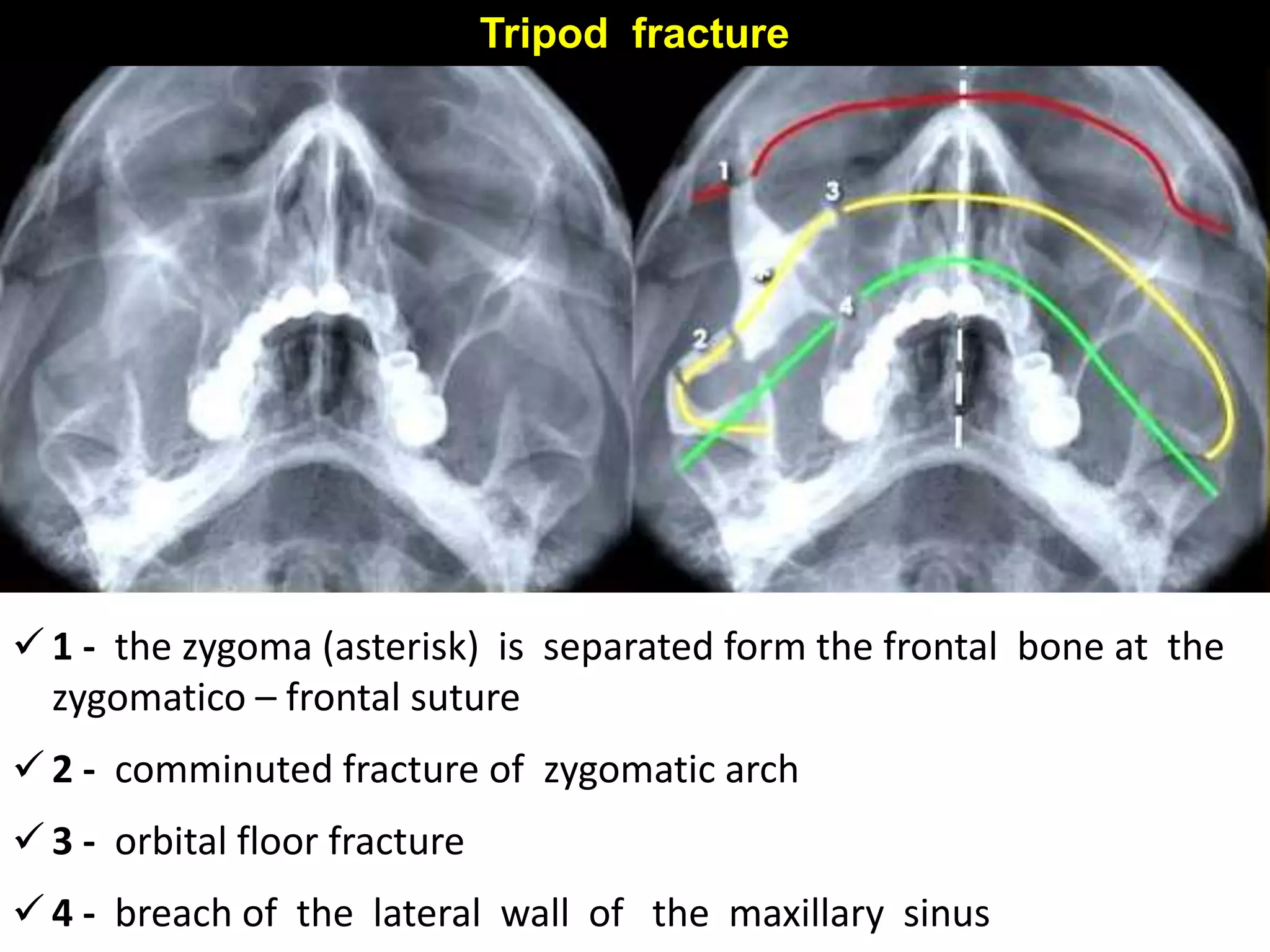 Tripod fracture
 1 - the zygoma (asterisk) is separated form the frontal bone at the
zygomatico – frontal suture
 2 - comminuted fracture of zygomatic arch
 3 - orbital floor fracture
 4 - breach of the lateral wall of the maxillary sinus
 