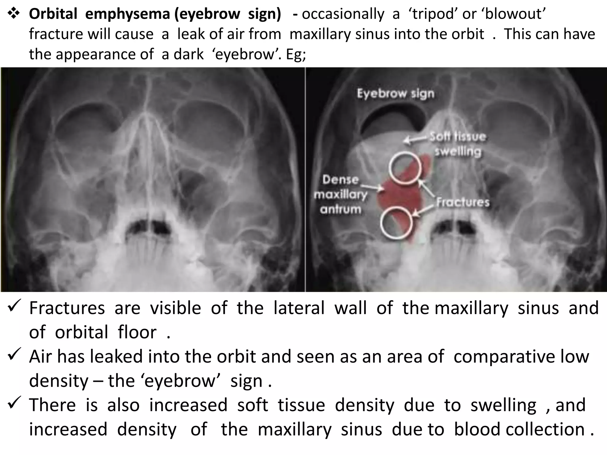  Fractures are visible of the lateral wall of the maxillary sinus and
of orbital floor .
 Air has leaked into the orbit and seen as an area of comparative low
density – the ‘eyebrow’ sign .
 There is also increased soft tissue density due to swelling , and
increased density of the maxillary sinus due to blood collection .
 Orbital emphysema (eyebrow sign) - occasionally a ‘tripod’ or ‘blowout’
fracture will cause a leak of air from maxillary sinus into the orbit . This can have
the appearance of a dark ‘eyebrow’. Eg;
 