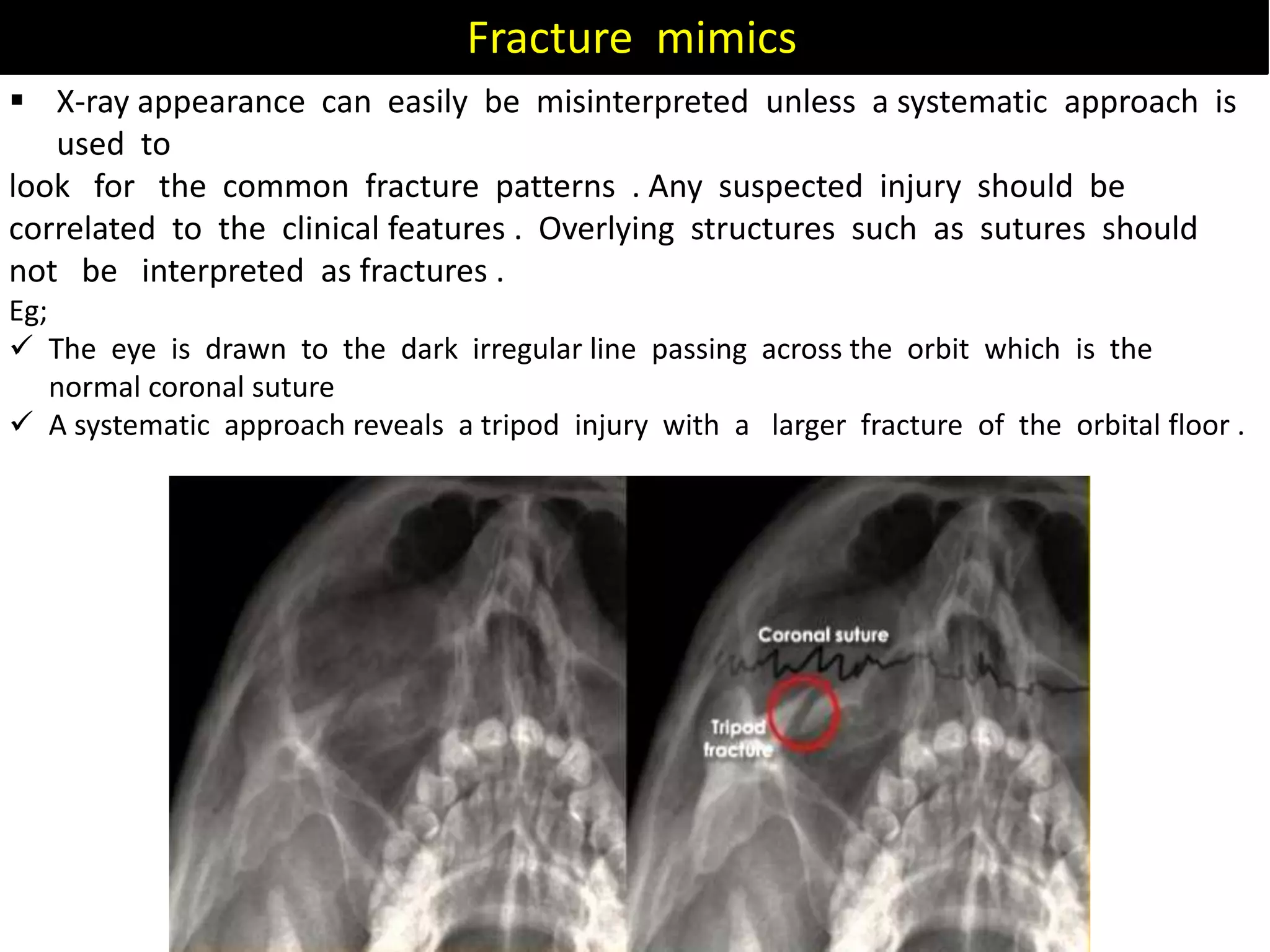 Fracture mimics
 X-ray appearance can easily be misinterpreted unless a systematic approach is
used to
look for the common fracture patterns . Any suspected injury should be
correlated to the clinical features . Overlying structures such as sutures should
not be interpreted as fractures .
Eg;
 The eye is drawn to the dark irregular line passing across the orbit which is the
normal coronal suture
 A systematic approach reveals a tripod injury with a larger fracture of the orbital floor .
 