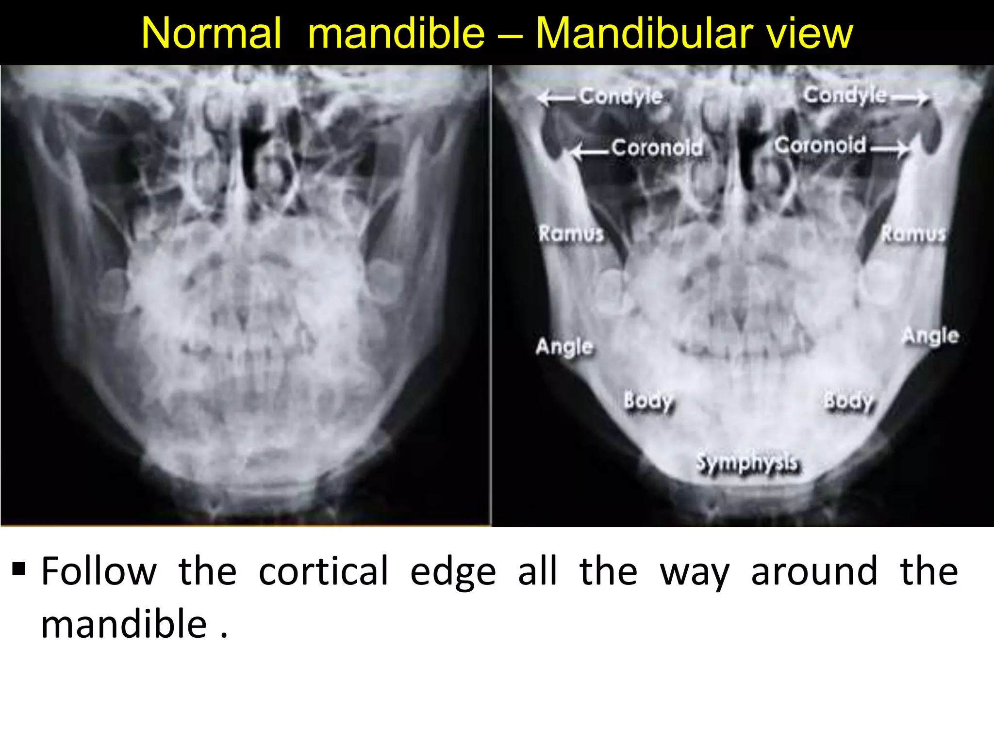 Normal mandible – Mandibular view
 Follow the cortical edge all the way around the
mandible .
 