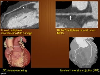 Anatomy and imaging of coronary artery disease with | PPT