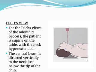 Fuchs Technique ANATOMY AND IMAGING OF THE SPINE AND TM.pptx