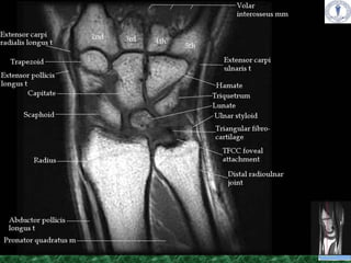 Wrist Injection Radiology Anatomy and imaging of wrist joint (MRI AND XRAY) | PPTX