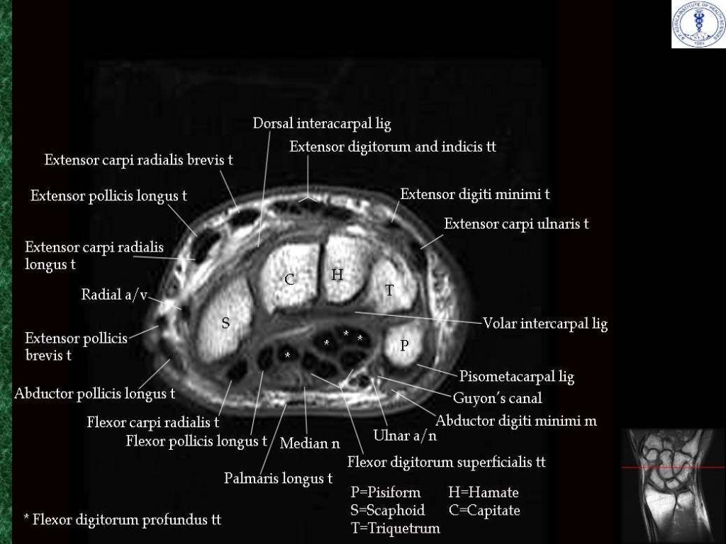 Anatomy and imaging of wrist joint (MRI AND XRAY)