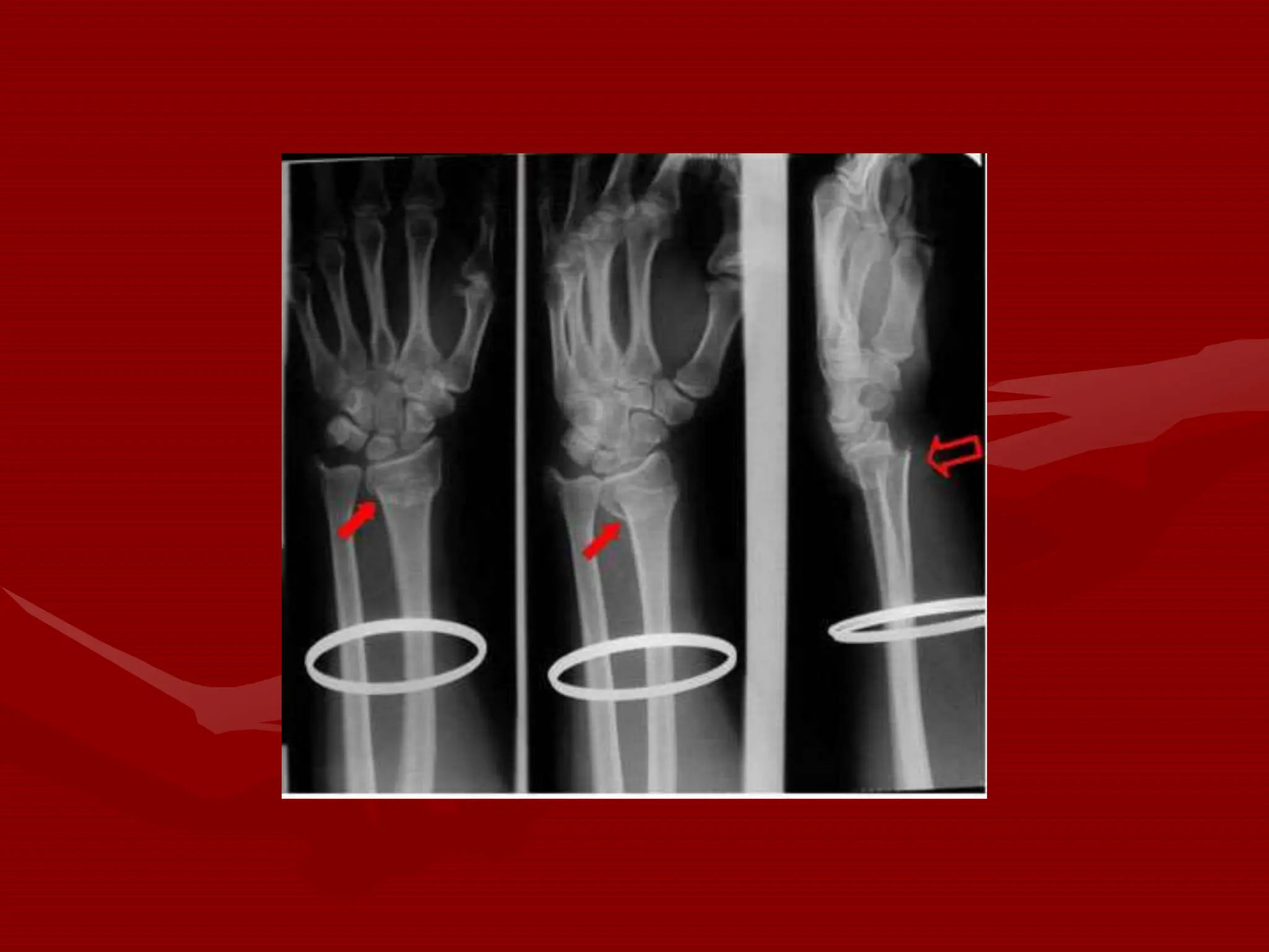 Anatomy and Injuries to the Wrist and Hand.ppt