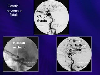 Anatomy and intervention in cerebral vasculature | PPTX