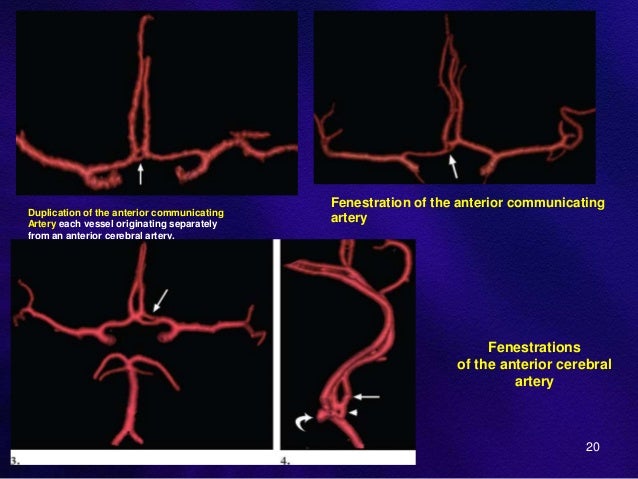 Anatomy and intervention in cerebral vasculature