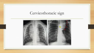 Stuart Sign Cervical Anatomy and pathology of mediastinum him.pptx