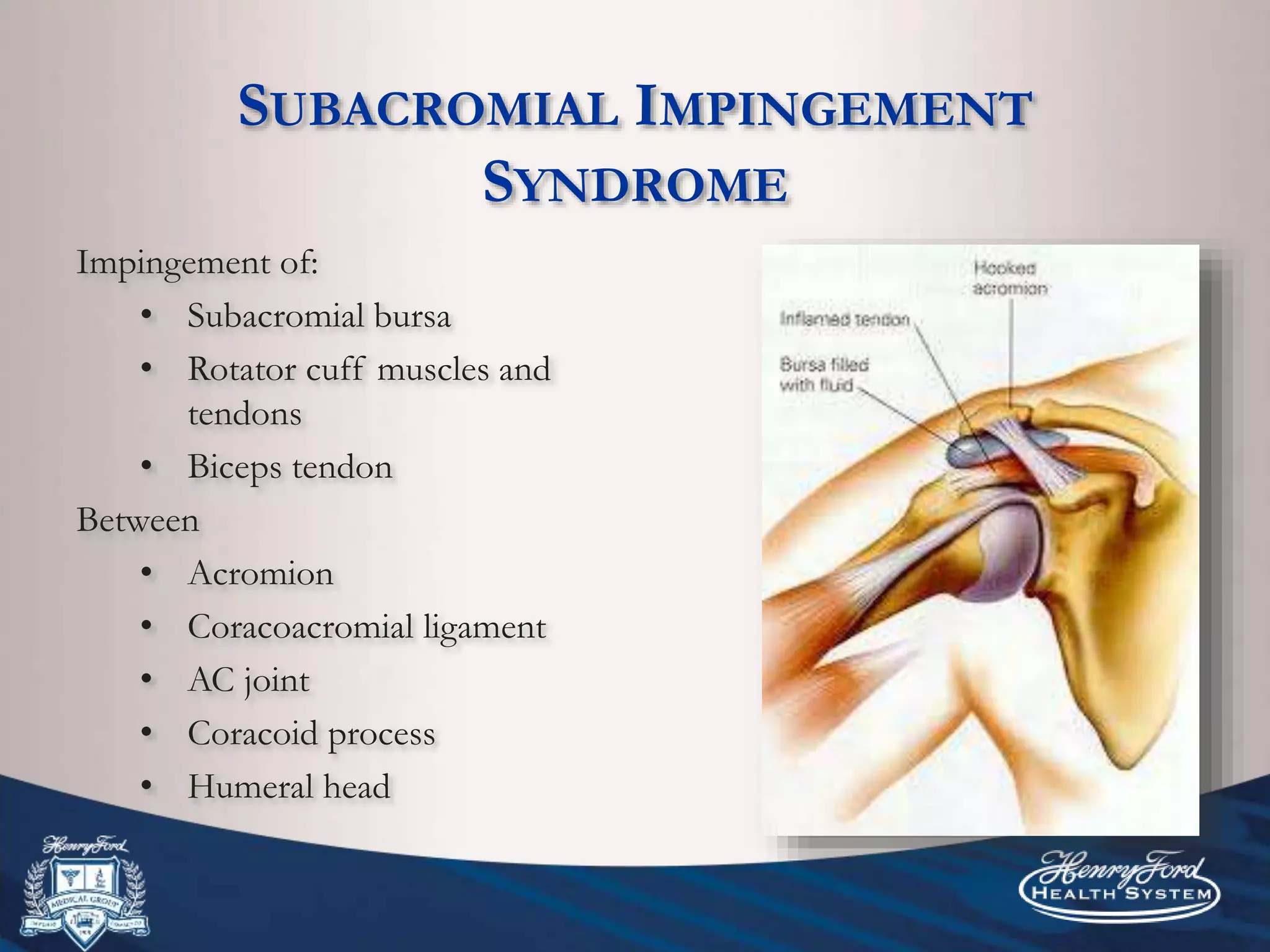 SUBACROMIAL IMPINGEMENT
SYNDROME
Impingement of:
• Subacromial bursa
• Rotator cuff muscles and
tendons
• Biceps tendon
Between
• Acromion
• Coracoacromial ligament
• AC joint
• Coracoid process
• Humeral head
 