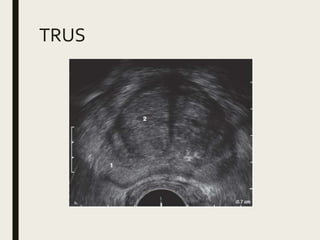 Trus Urology Example Anatomy and physiology of prostate | PPTX