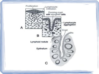 Tonsil Crypt Anatomy
