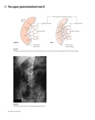 40 Abdomen and pelvis
16 The upper gastrointestinal tract II
Thicker wall
(feels full)
Jejunal branches
Redder
wall
Ileal branches
From superior mesenteric artery
Thinner wall
(feels empty)
Simple arcades Multiple arcades
Fig.16.1
The jejunum and the ileum can be distinguished by their colour, feel and the complexity of the arterial arcades
Fig.16.2
Small bowel obstruction, showing dilated bowel loops
Jejunum Ileum
 