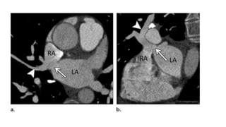 Svc Rupture ANATOMY EMBRYOLOGY AND IMAGING OF SVC.pptx