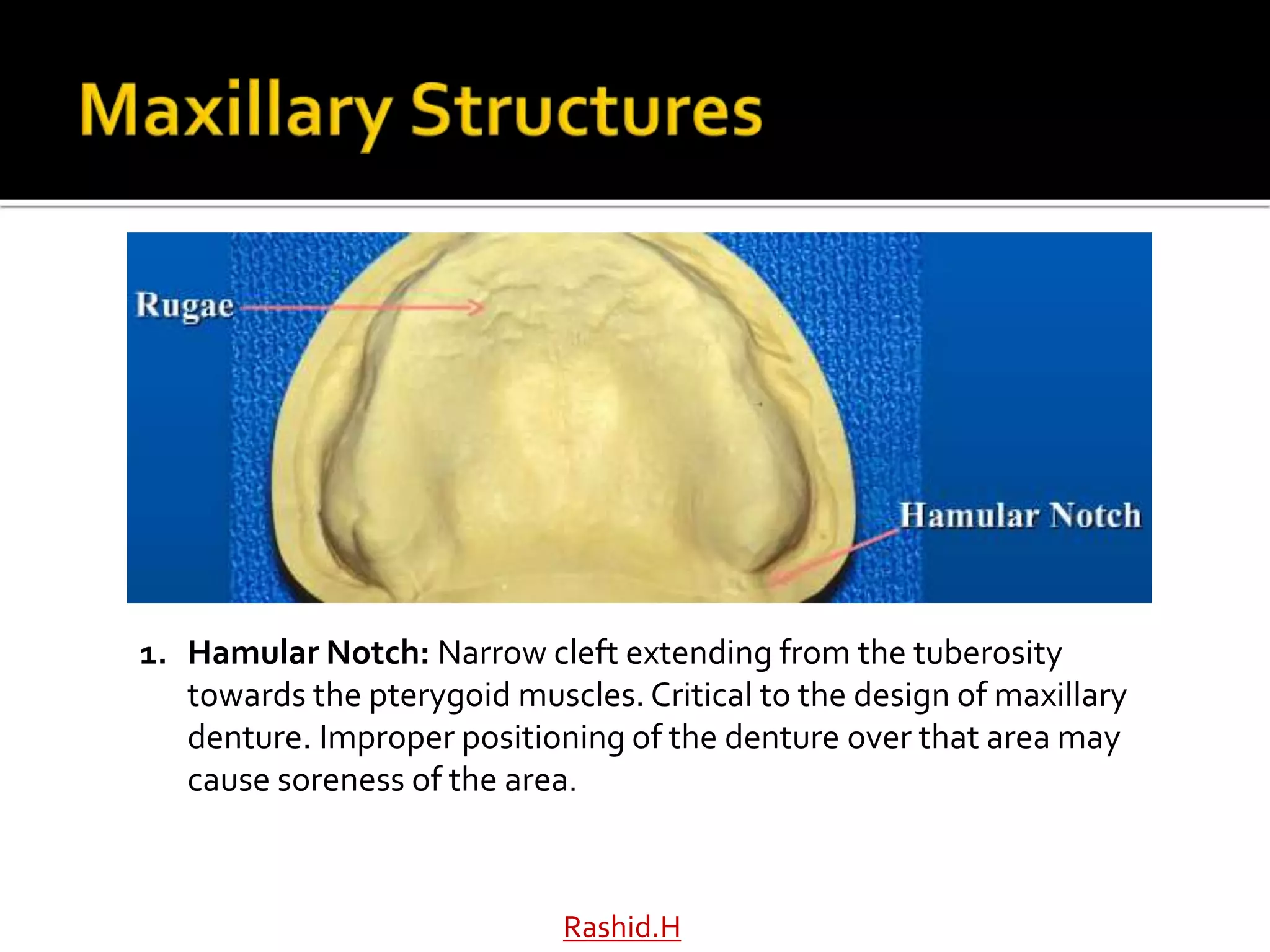 Rashid.H
1. Hamular Notch: Narrow cleft extending from the tuberosity
towards the pterygoid muscles. Critical to the design of maxillary
denture. Improper positioning of the denture over that area may
cause soreness of the area.
 