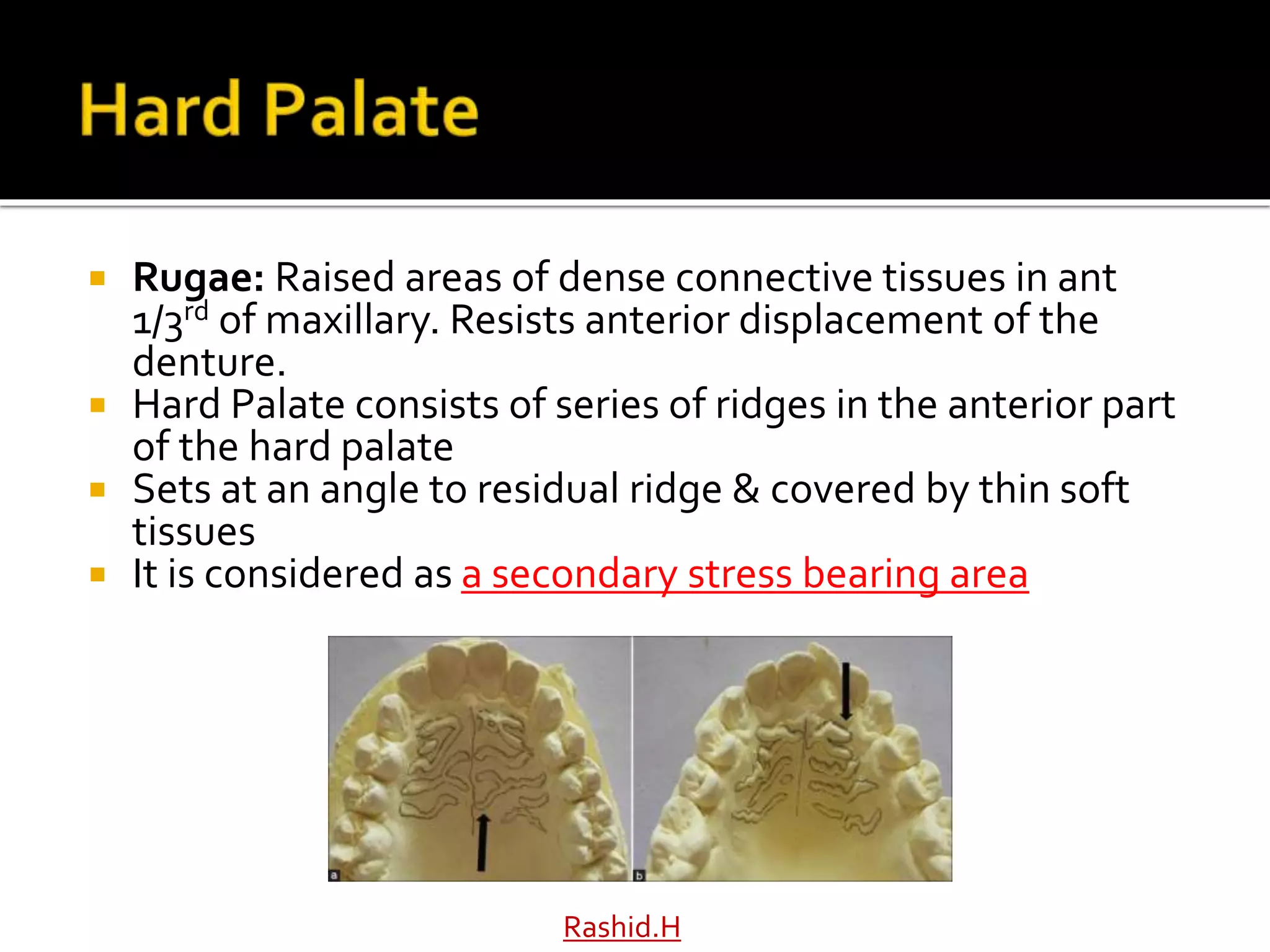  Rugae: Raised areas of dense connective tissues in ant
1/3rd of maxillary. Resists anterior displacement of the
denture.
 Hard Palate consists of series of ridges in the anterior part
of the hard palate
 Sets at an angle to residual ridge & covered by thin soft
tissues
 It is considered as a secondary stress bearing area
Rashid.H
 