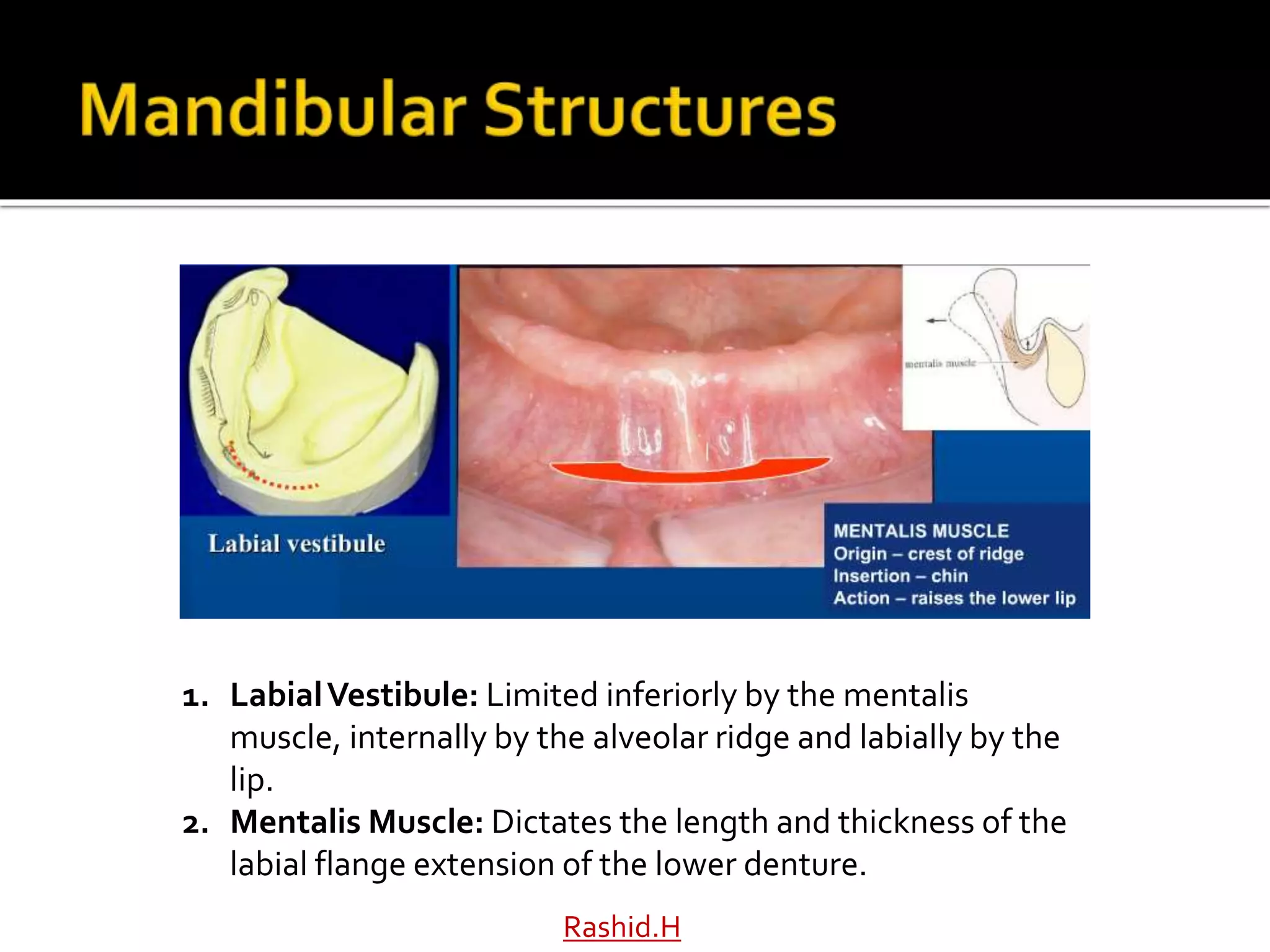 1. LabialVestibule: Limited inferiorly by the mentalis
muscle, internally by the alveolar ridge and labially by the
lip.
2. Mentalis Muscle: Dictates the length and thickness of the
labial flange extension of the lower denture.
Rashid.H
 