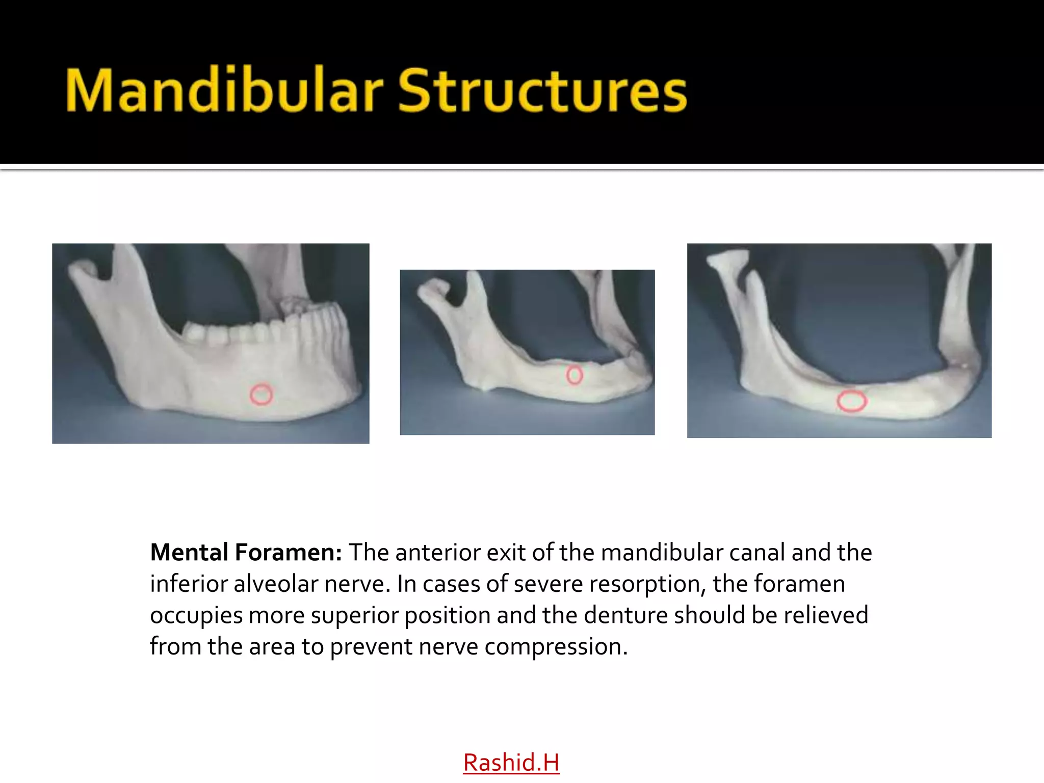 Rashid.H
Mental Foramen: The anterior exit of the mandibular canal and the
inferior alveolar nerve. In cases of severe resorption, the foramen
occupies more superior position and the denture should be relieved
from the area to prevent nerve compression.
 
