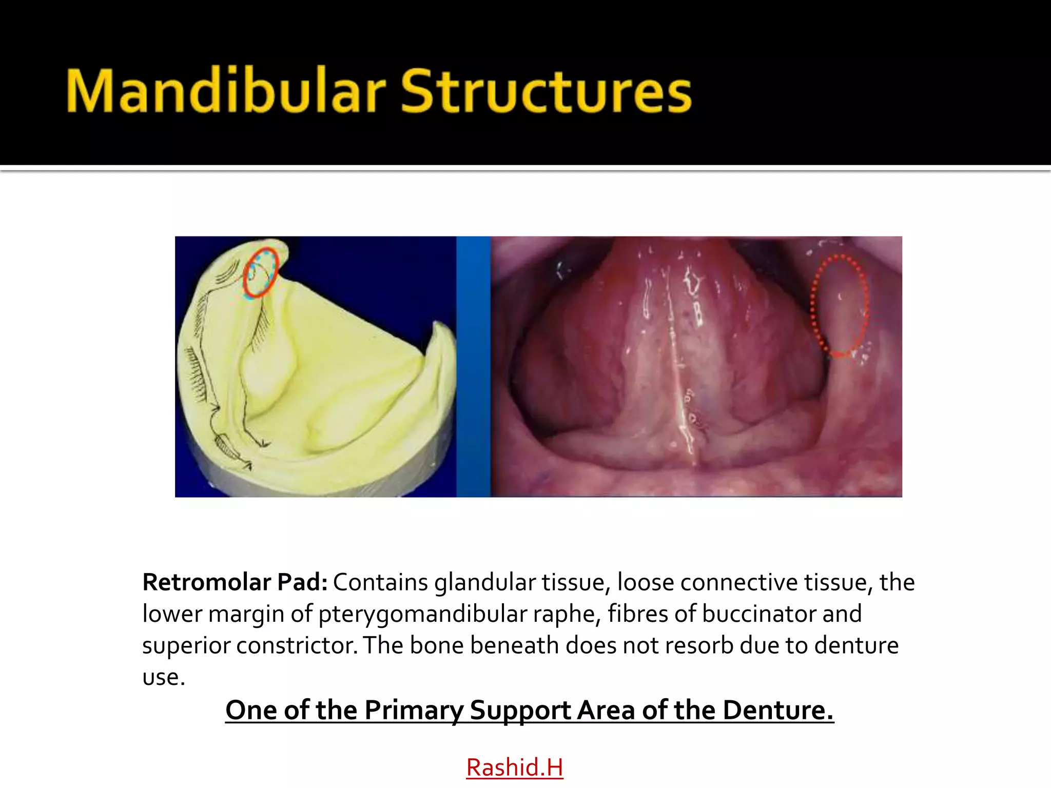 Rashid.H
Retromolar Pad: Contains glandular tissue, loose connective tissue, the
lower margin of pterygomandibular raphe, fibres of buccinator and
superior constrictor.The bone beneath does not resorb due to denture
use.
One of the Primary Support Area of the Denture.
 