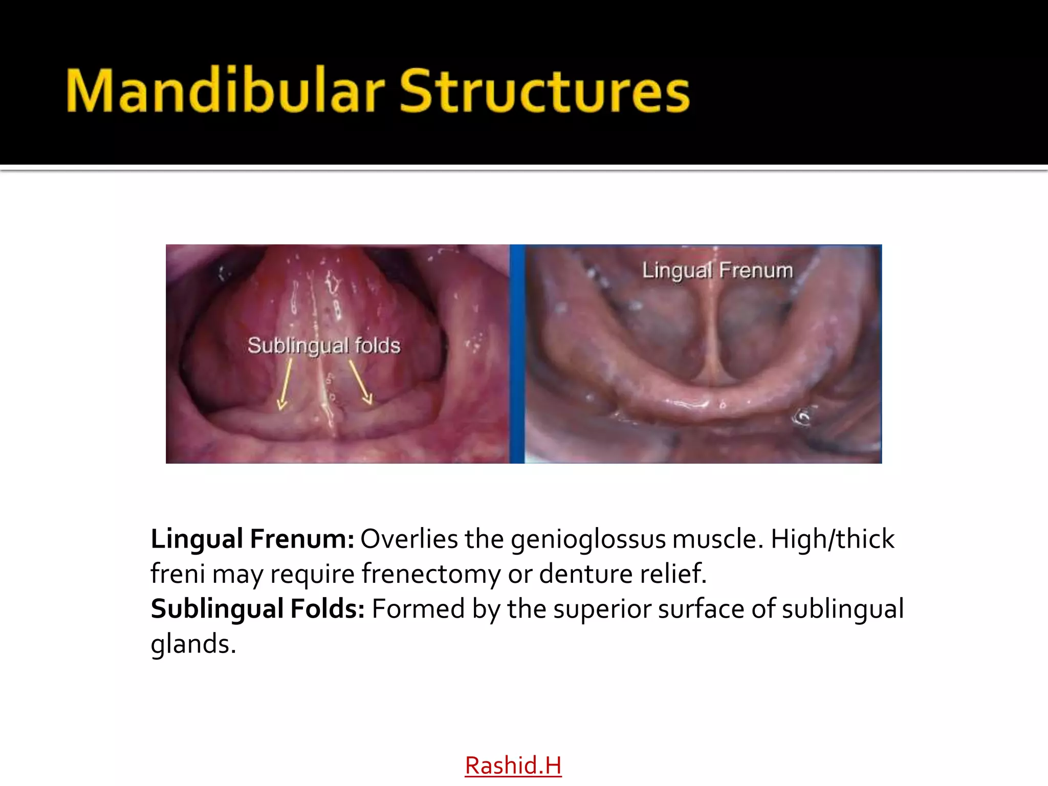 Rashid.H
Lingual Frenum: Overlies the genioglossus muscle. High/thick
freni may require frenectomy or denture relief.
Sublingual Folds: Formed by the superior surface of sublingual
glands.
 