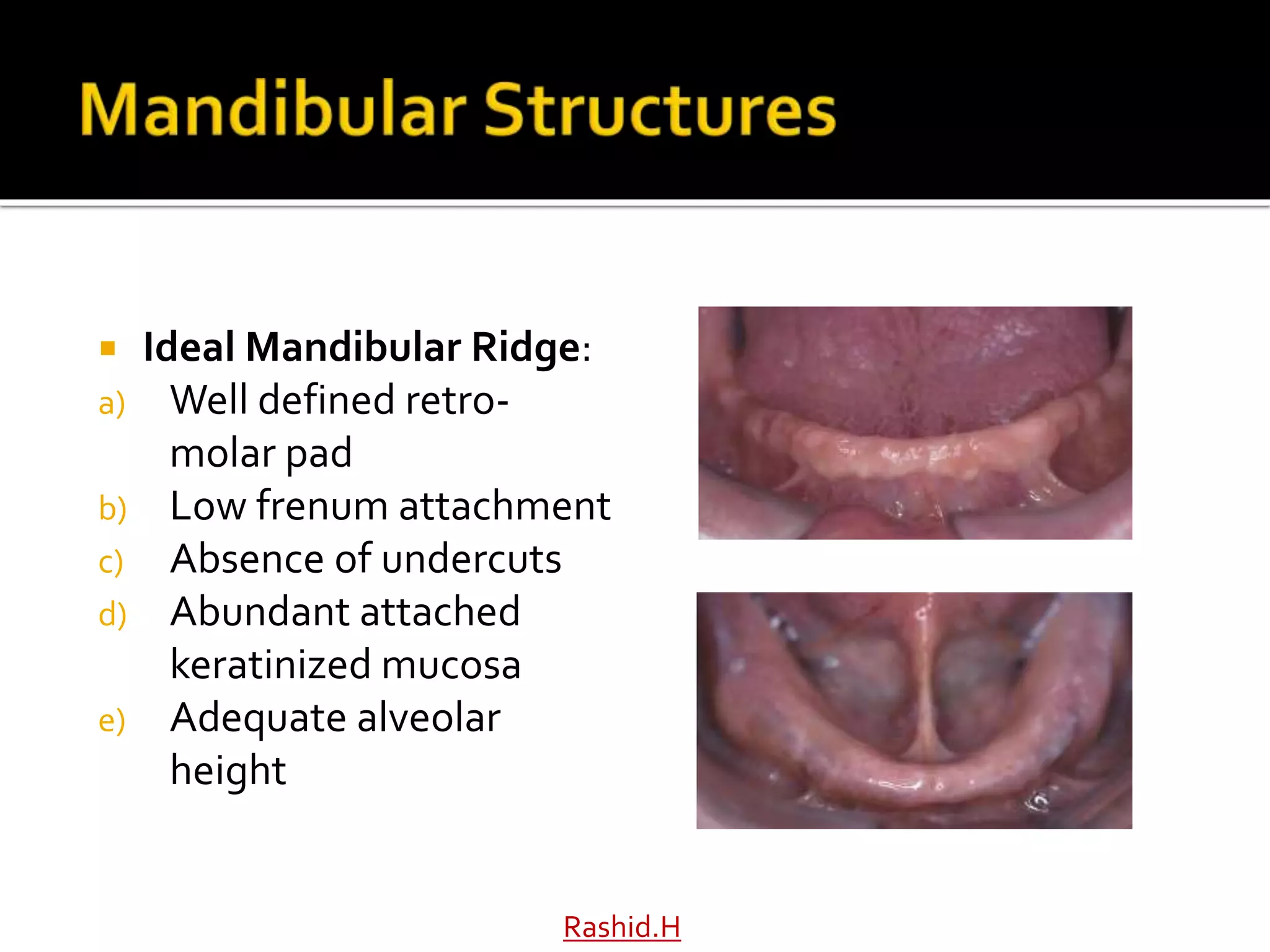  Ideal Mandibular Ridge:
a) Well defined retro-
molar pad
b) Low frenum attachment
c) Absence of undercuts
d) Abundant attached
keratinized mucosa
e) Adequate alveolar
height
Rashid.H
 