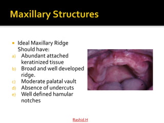 Split Ridge Maxilla Anatomy for Complete and Partial Dentures (1).pptx