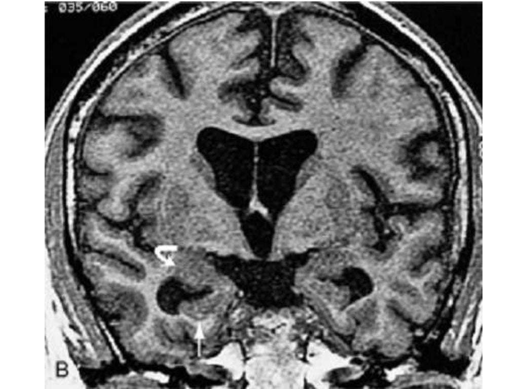 anatomy-of-hippocampus-radiology