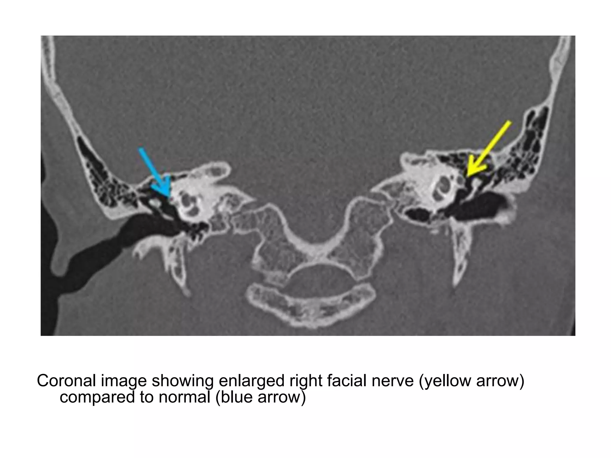 Interventional Neuroradiology: Anatomy of the internal carotid artery ...